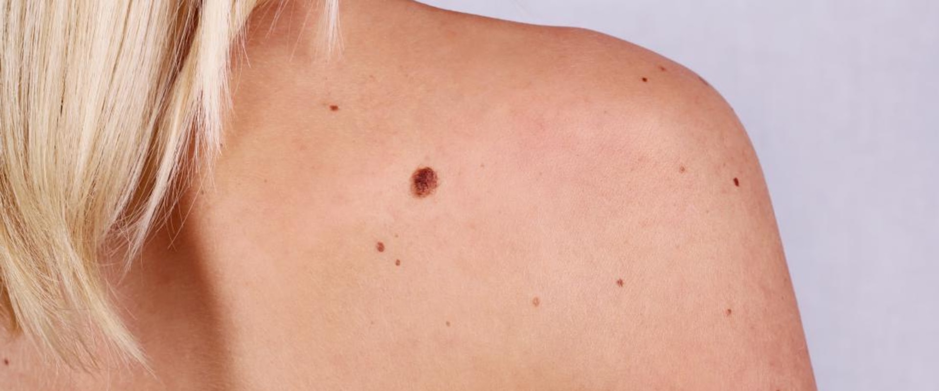 alternative-treatments-for-mole-removal