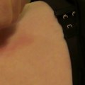 Tying Off a Skin Tag With a Thread or String