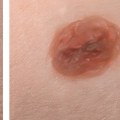 The Dangers of Long-term Skin Damage from Mole Removal