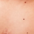 Aftercare Tips for Mole Removal Procedures: Avoiding Trauma to the Area
