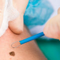 Cauterization: Everything You Need to Know about Non-Surgical Mole Removal