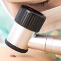 Natural Remedies for Mole Removal Procedures