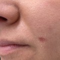 The Risks Associated with Non-Surgical Mole Removal Procedures: Changes in Skin Color at the Treatment Site