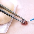 Burning a Skin Tag with an Electric Current