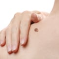 Managing Pain and Discomfort After Mole Removal Surgery