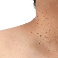 Natural remedies for skin tag removal: Non-surgical procedures