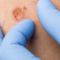 The Risks of Damage to Surrounding Tissue During Mole Removal