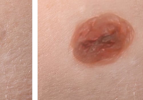 The Dangers of Long-term Skin Damage from Mole Removal