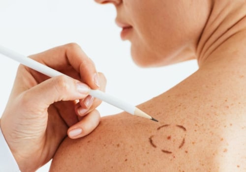 Chemical Treatments for Skin Tag Removal