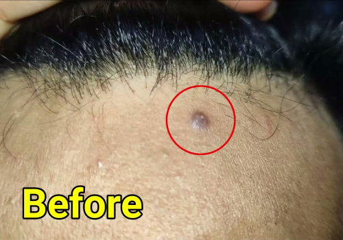 Apple Cider Vinegar Remedy: A Home Remedy for Mole Removal