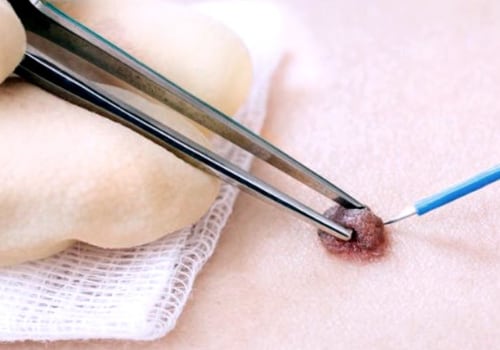 Burning a Skin Tag with an Electric Current