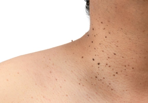 Natural remedies for skin tag removal: Non-surgical procedures