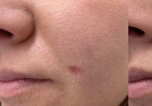 Laser Mole Removal Aftercare: Tips and Advice