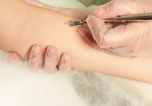 Laser Mole Removal Cost - A Comprehensive Overview